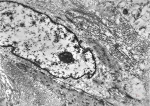 M,52y. | myofibroblastic tumor - pleura M,52y. | myofibroblastic tumor - pleura